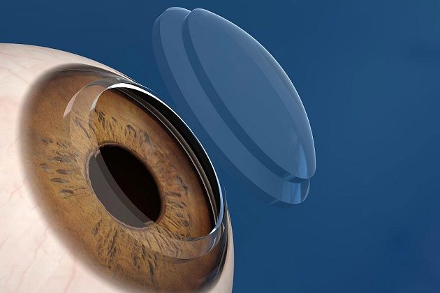 Trifocal Intraocular Lens