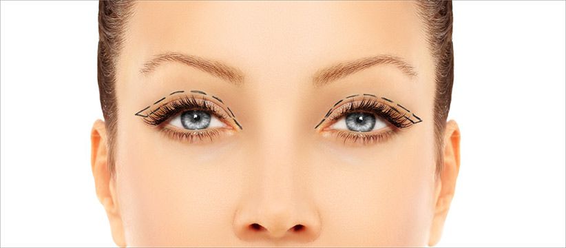 Blepharoplasty (Eyelid Surgery)