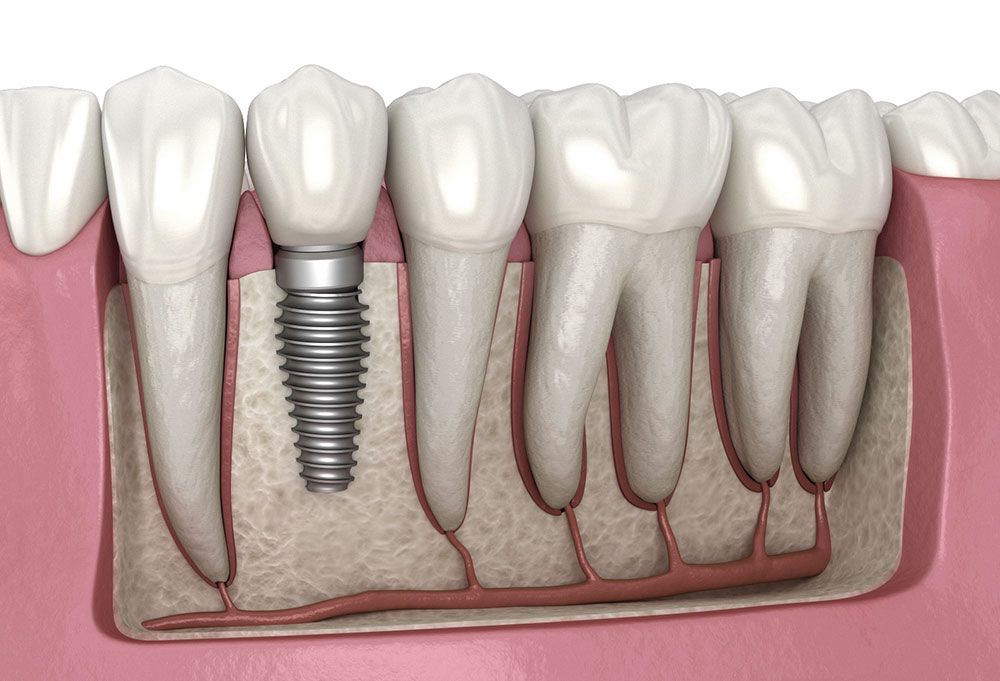 dental implants