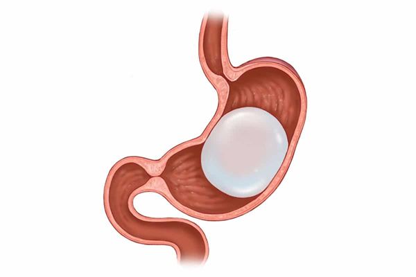 Gastric Balloon