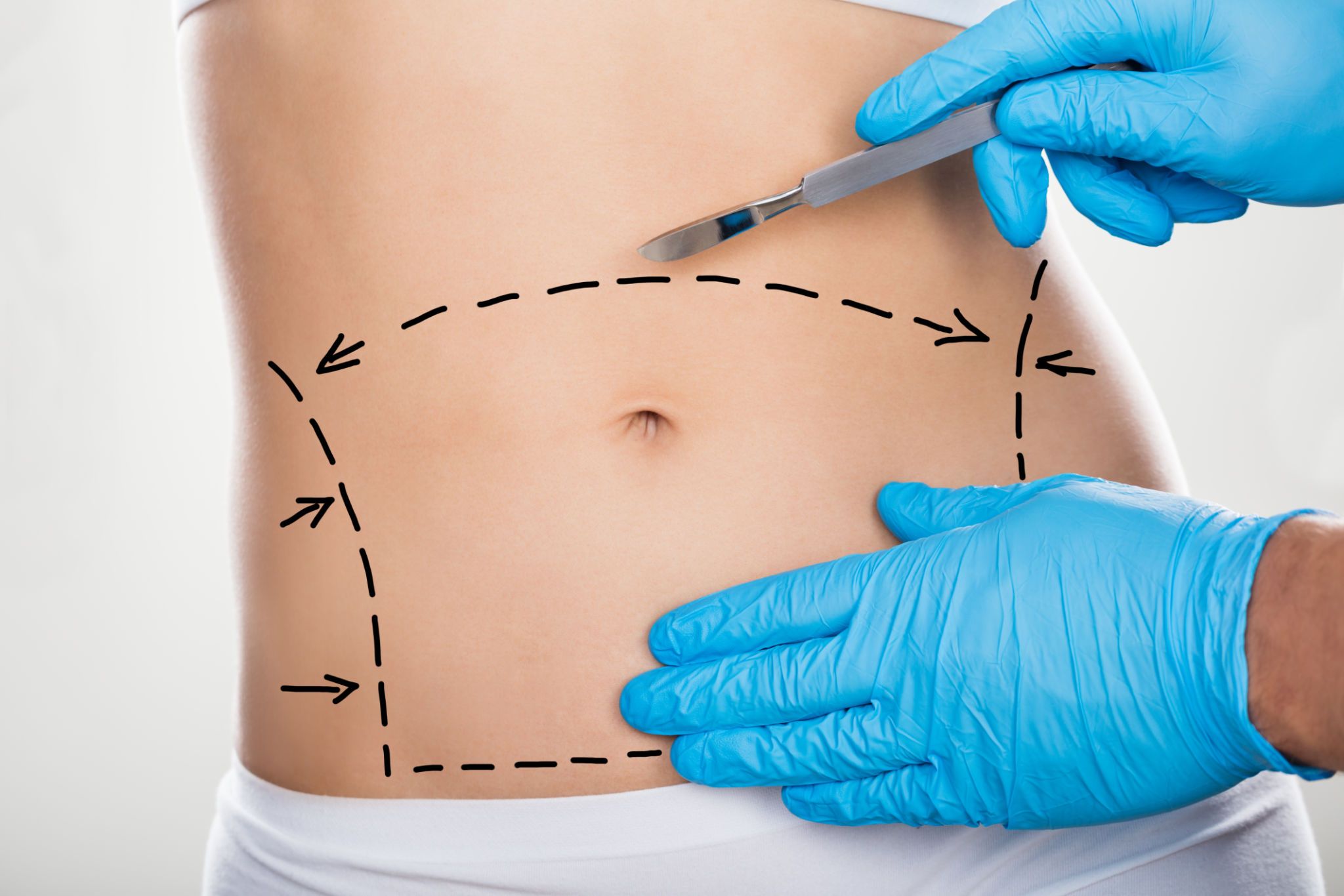 Abdominoplasty (Tummy Tuck)