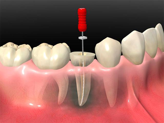 Endodontic Treatment (Root Canal)