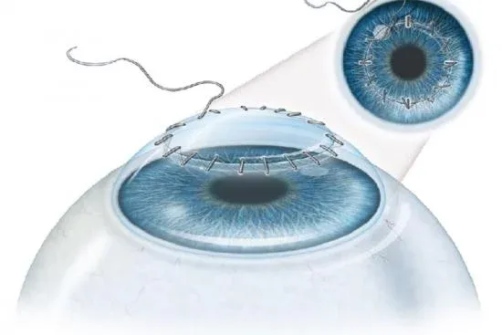 Keratoplasty (Cornea Transplant)