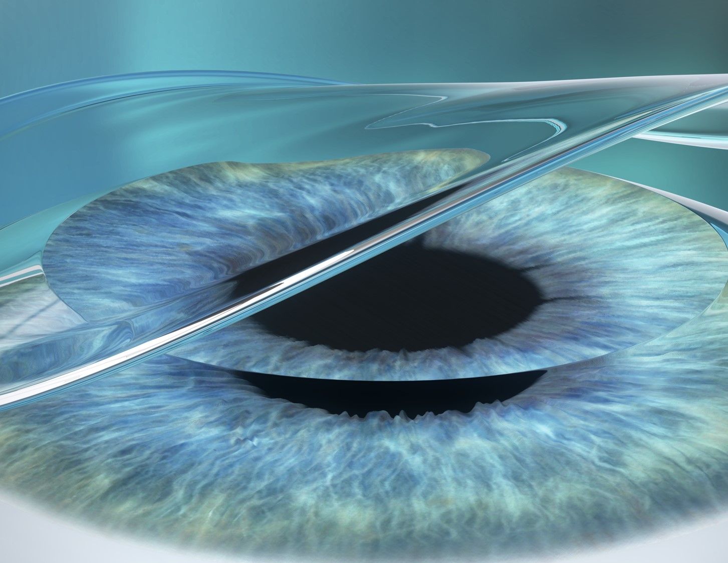 Femtosecond-Assisted LASIK