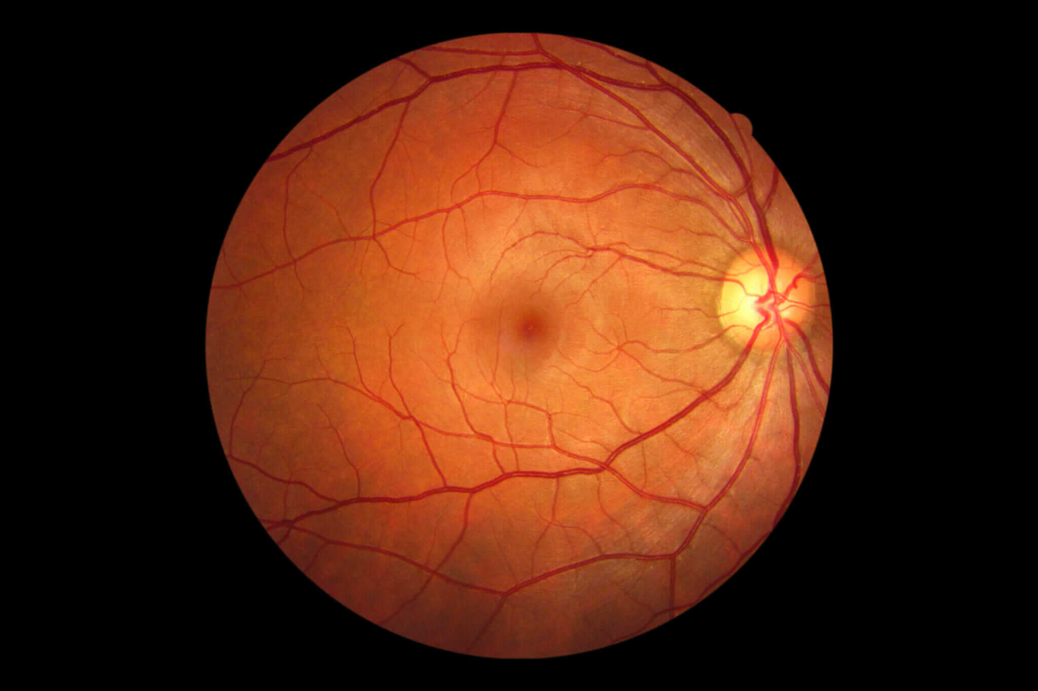 Diabetic Retinopathy Surgery (Vitrectomy)