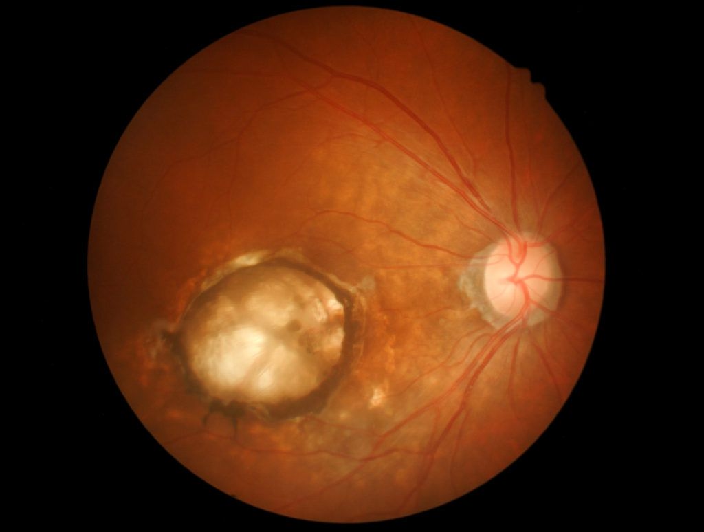 Macular Hole