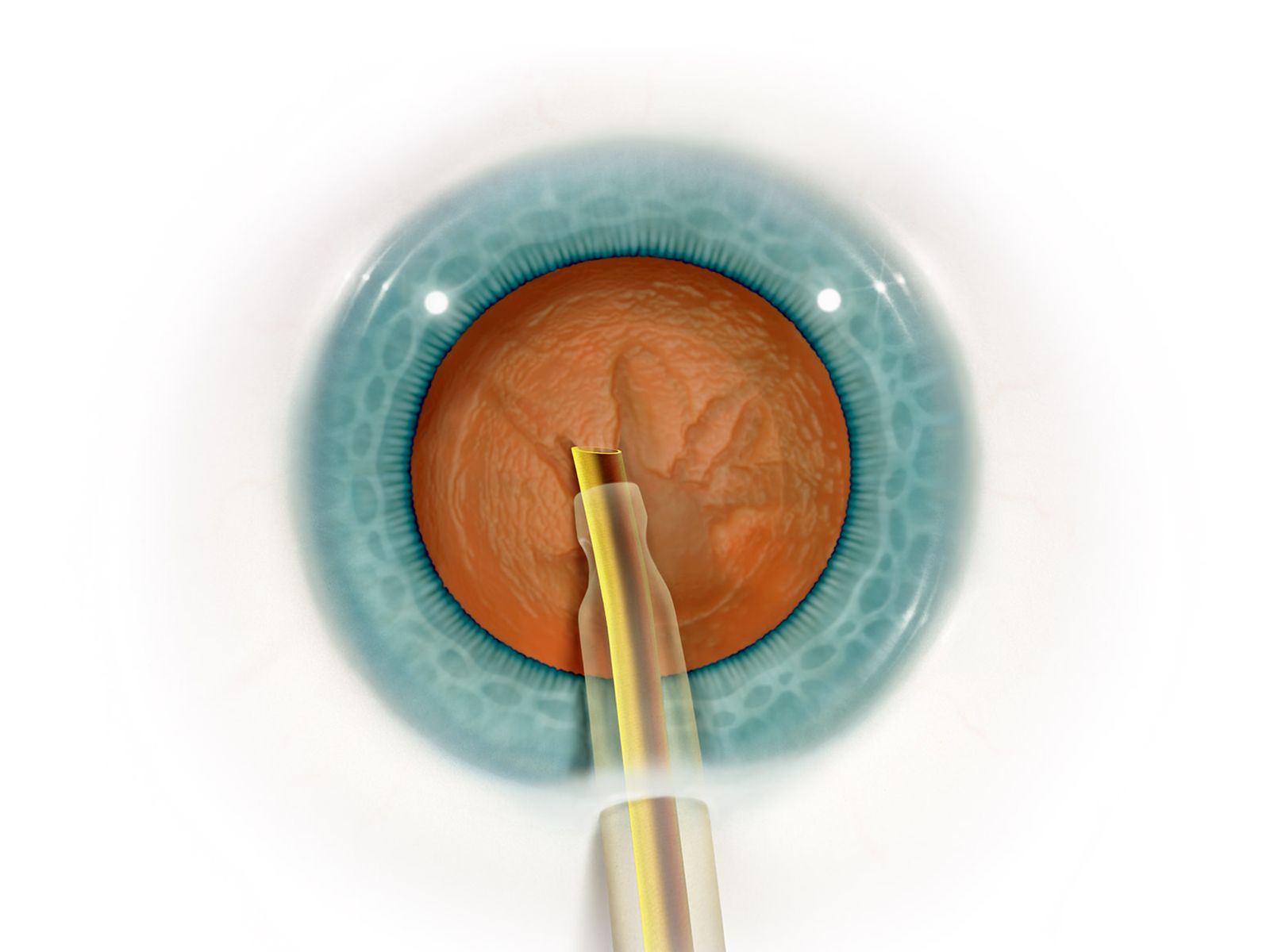 Phacoemulsification (Phaco)