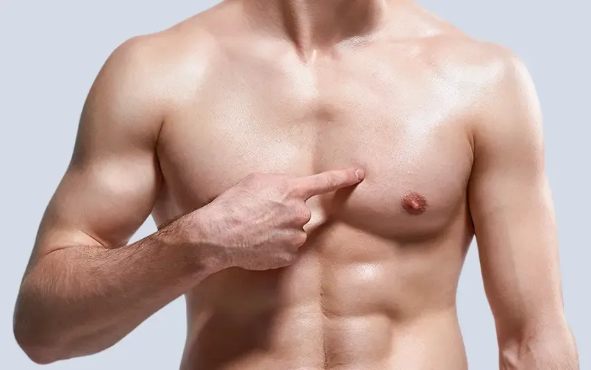 Gynecomastia Surgery